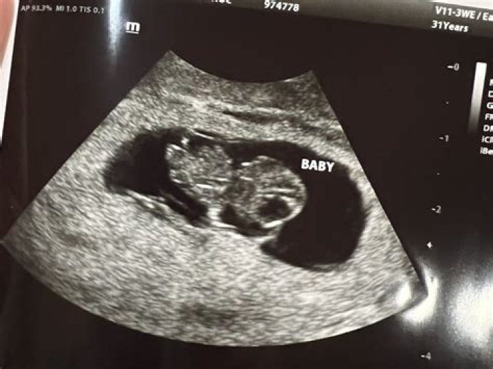 Pregnant Woman Posts Ultrasound Photo Of Her Baby Flexing His Muscles While In Her Womb